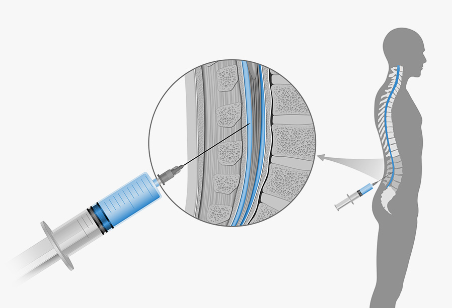 Myelogram