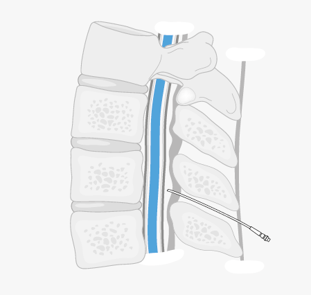 Epidural Injection