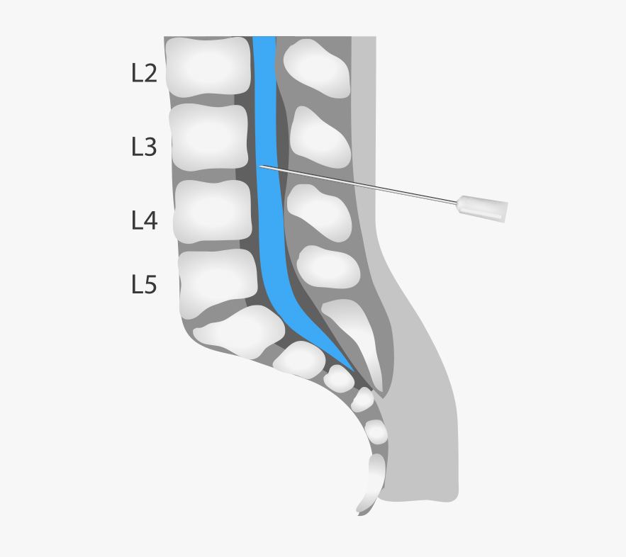 Lumbar Puncture