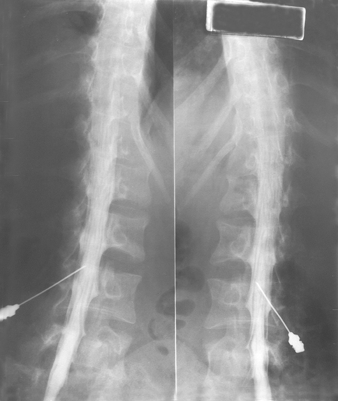 Myelogram Xray